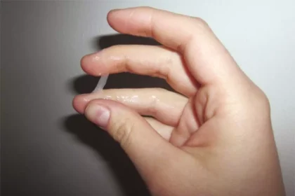 виділення при молочниці